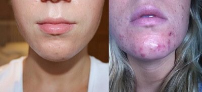 טיפול באקנה לפני אחרי